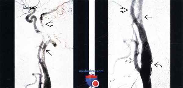 МРТ, ангиограмма при персистирующей артерии проатланта