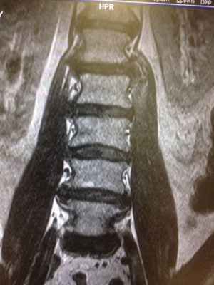 Рентген повздошно-поясничной мышцы