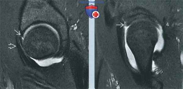 Признаки подвздошно-поясничного импинджмента на артрограмме