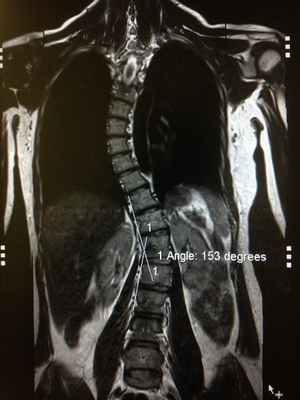 МРТ диагностика синдром повздошно-поясничной мышцы
