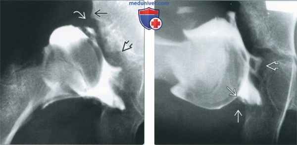 Признаки дисплазии тазобедренного сустава на артрограмме