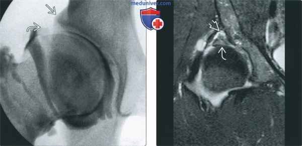 Признаки дисплазии тазобедренного сустава на артрограмме