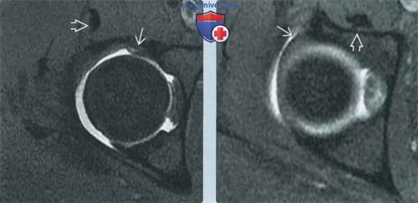 Признаки подвздошно-поясничного импинджмента на артрограмме