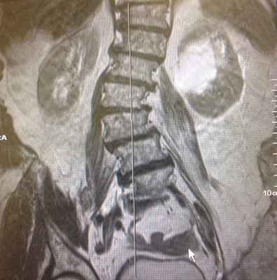 Синдром повздошно-поясничной мышцы