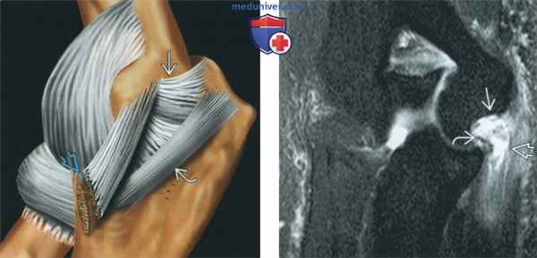Признаки повреждения локтевой коллатеральной связки на артрограмме