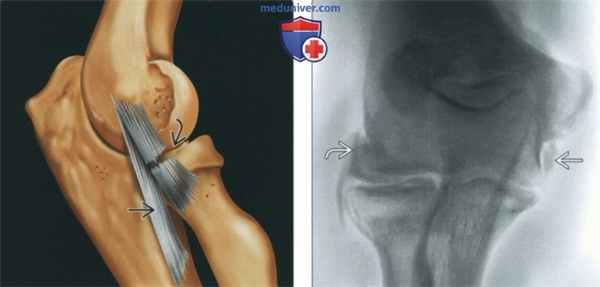 Признаки повреждения лучевой коллатеральной связки на артрограмме