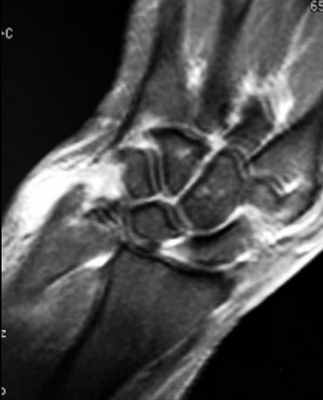 гигантоклеточная опухоль - Т1+конт