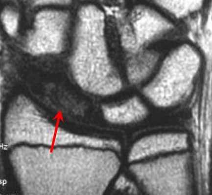 аспт некроз