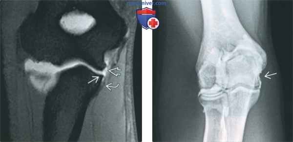 Признаки повреждения локтевой коллатеральной связки на артрограмме