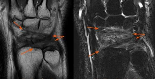 повреждение связок-обр