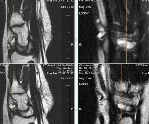 МРТ кисти: когда назначается?