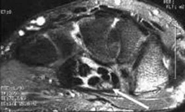 МРТ кисти: когда назначается?