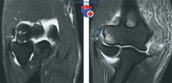 Признаки повреждения лучевой коллатеральной связки на артрограмме