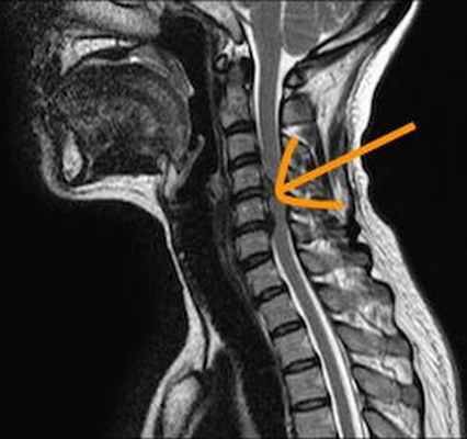МРТ снимок - грыжа шейного отдела позвоночника
