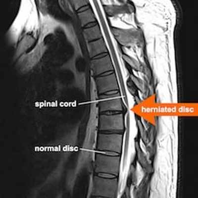 МРТ снимок - грыжа грудного отдела позвоночника