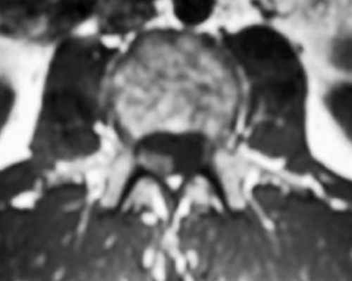 арахноидит акс