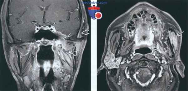 МРТ при атрофии жевательных мышц