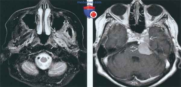 МРТ при атрофии жевательных мышц
