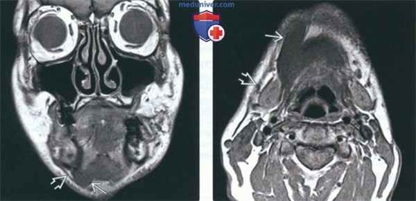 МРТ при атрофии жевательных мышц
