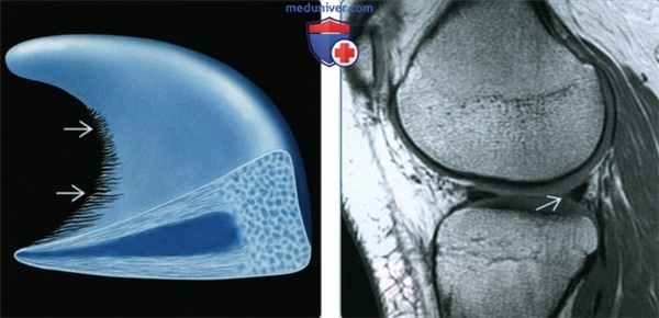 Признаки дегенерации менисков коленного сустава