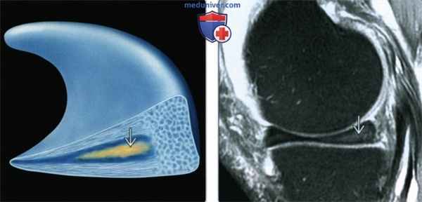 Признаки дегенерации менисков коленного сустава