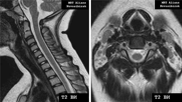 МРТ шейного отдела позвоночника норма