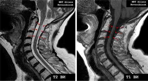 Рассеянный склероз