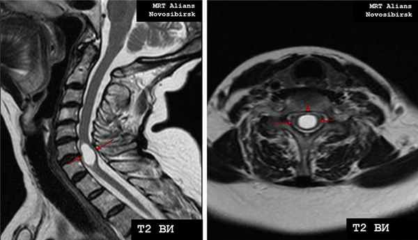 Гидросирингомиелия шейного отдела