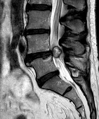 Ганглионарная киста позвоночника