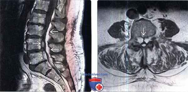 МРТ при эпидуральном липоматозе
