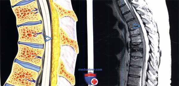 МРТ при эпидуральном липоматозе
