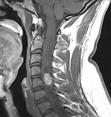 гемангиобластома