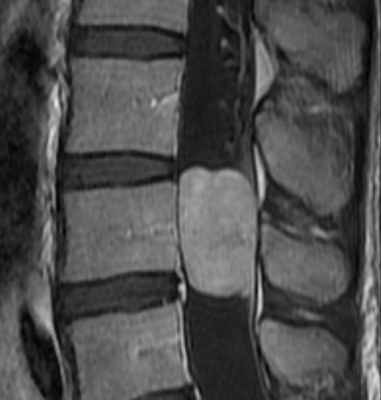 микс-эпендимома