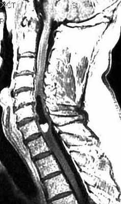 астроцитома