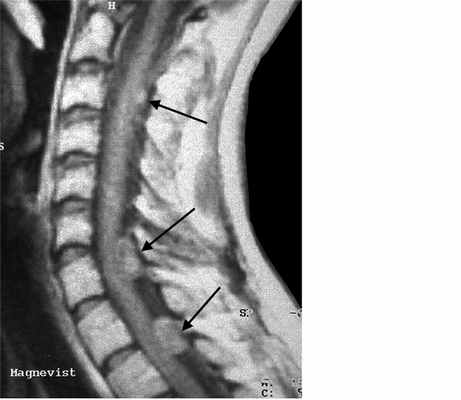 нейрофиброматоз