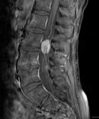 параганглиома
