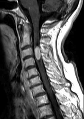 Эпендимома