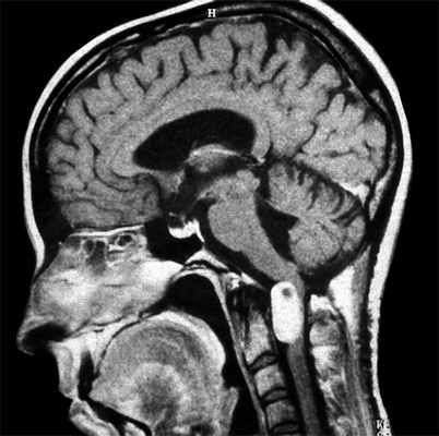 Менингиома С1