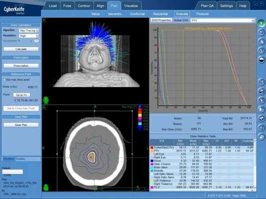 План радиохирургического лечения глиомы на КиберНоже