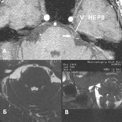 МРТ при нейроваскулярном конфликте