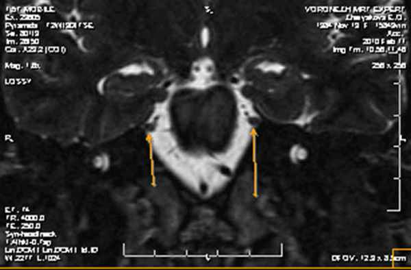 МРТ при нейроваскулярном конфликте