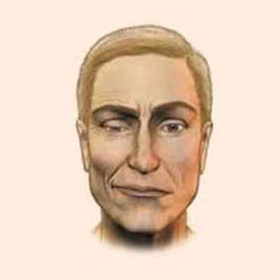 Гемифациальный спазм