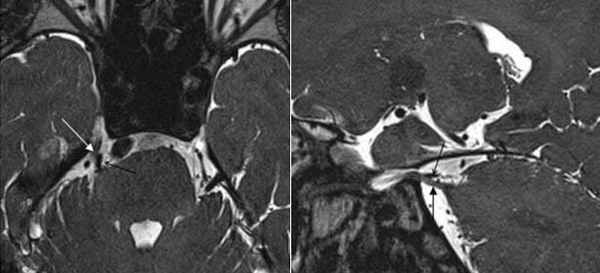 МРТ при нейроваскулярном конфликте