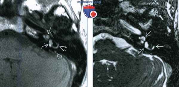 Интралабиринтное кровоизлияние (ИЛК) - лучевая диагностика