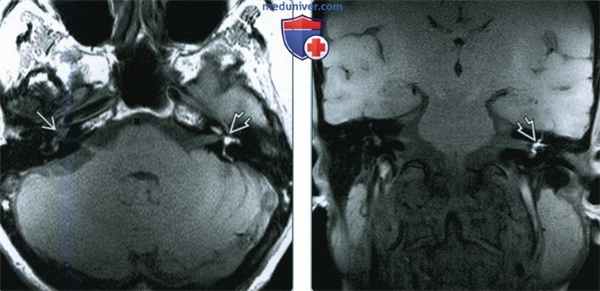 Интралабиринтное кровоизлияние (ИЛК) - лучевая диагностика