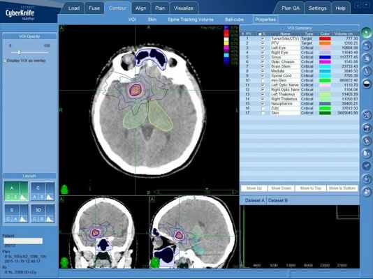 Радиохирургическое лечение каверномы без операции - план лечения на КиберНоже