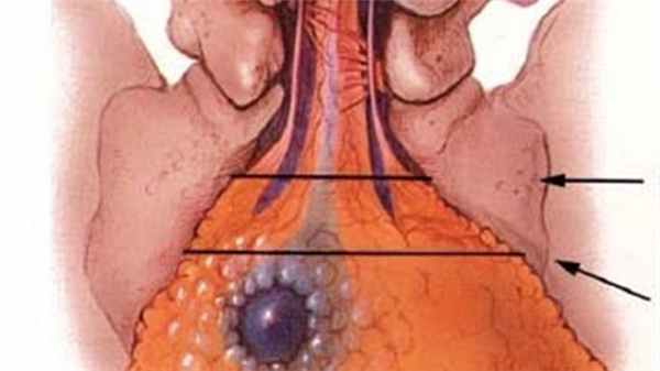 Липомиеломенингоцеле