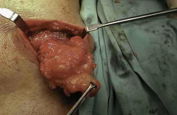 Липома - диагностика, методы лечения