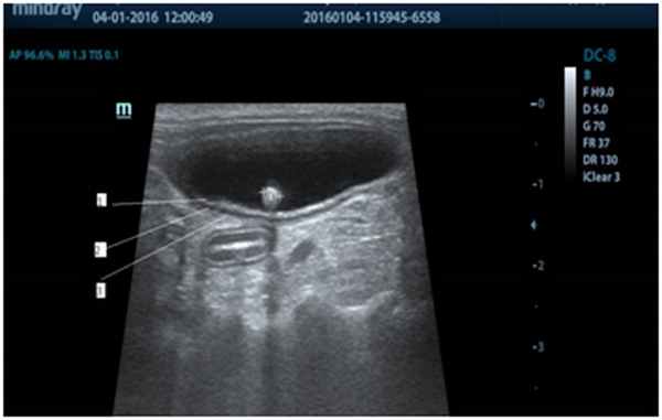 четко видны слои мочевого пузыря и уролит на дорсальной стенке с эхоакустической тенью