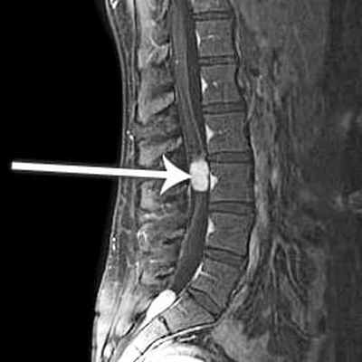Эпендимома позвоночника